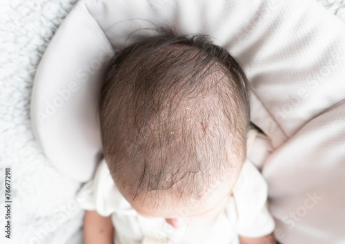 Seborrheic dermatitis crusts on the baby's head. Child with seborrhea in the hair, newborn skin problems photo