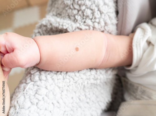 Dark brown mole on baby's right arm