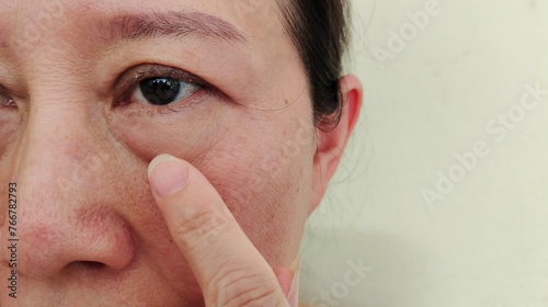 Portrait showing the finger holding the flabbiness and loose under the eye, dark spots and blemish, freckles and Flabby skin on the face of the woman, health care and beauty concept.