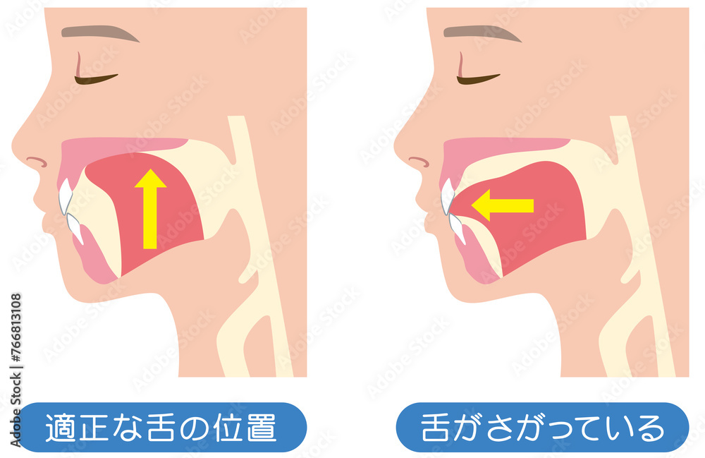 正しい舌の位置と下がっている舌の位置