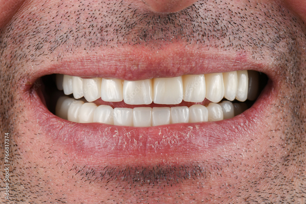 Obraz premium emax ceramic cowens on implants 