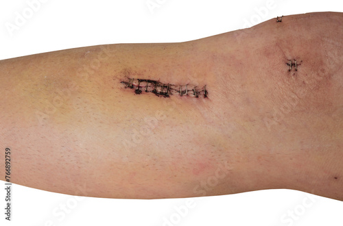 Human leg with surgical staples for sutures. Wounds following Anterior Cruciate Ligament Reconstruction