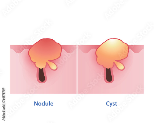 The difference between nodule and cyst vector on white background. Nodular is firm, painful, red bump on the surface skin. Cystic acne consist of deep, pus filled. The both are inflammatory severe.