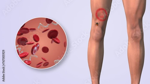 CDC in blood cells with lyme disease on thighs photo