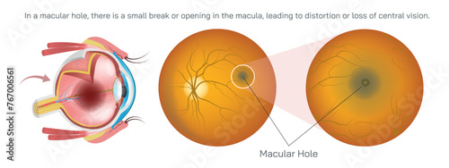 macula is responsible for sharp vision to do activities like reading and driving. In a macular hole, there is a small break or opening in the macula, leading to distortion or loss of vision vector.