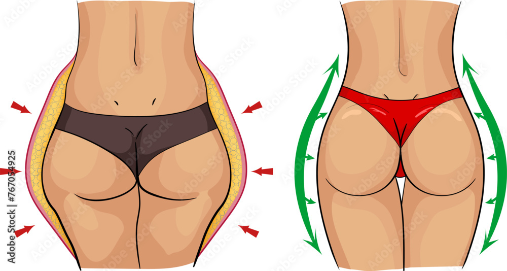Vector illustration of body transformation while fitness, dieting or surgery. Illustration of problematic women's body parts transforming to perfect slim fit silouhette. Transforming women's buttocks Vector illustration of body transformation while fitness, dieting or surgery. Illustration of problematic women's body parts transforming to perfect slim fit silouhette. Transforming women's buttocks