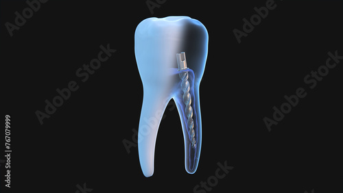 Dental steel post inside molar teeth, Xray view. Dental endodontic treatment 3D render illustration photo