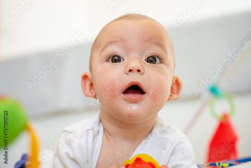 Close-up portrait of a baby with atopic dermatitis on the skin, redness of the cheeks, rash, eczema or hives caused by infection or excessive salivation from teething. newborn health and care concept