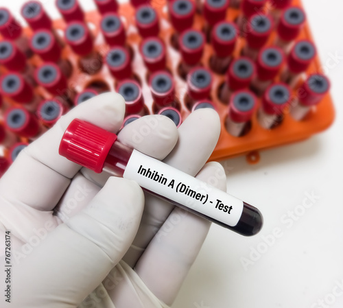 Blood sample for Inhibin A test, tumor marker tests measure these blood hormone levels to help detect a rare ovarian granulosa cell tumor. photo