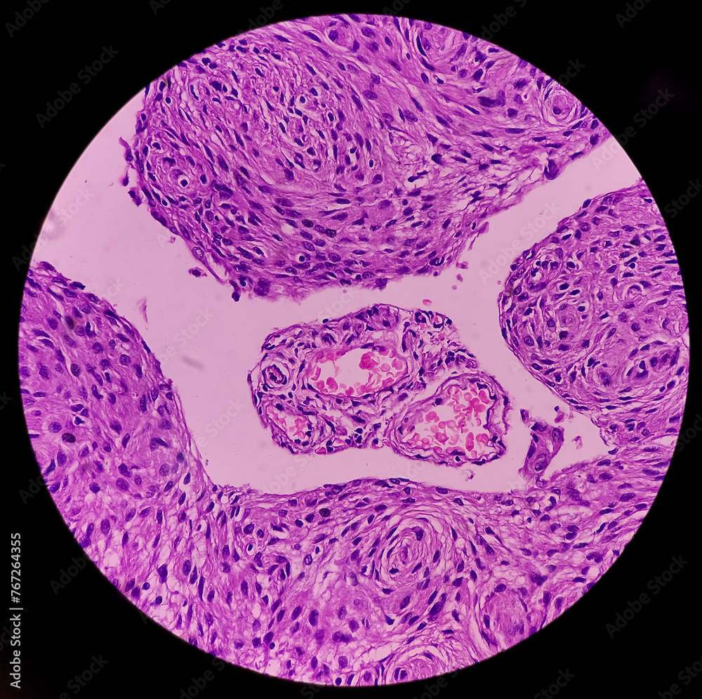 Parietal lesion(biopsy): Brain cancer, Meningioma, show neoplasm of ...