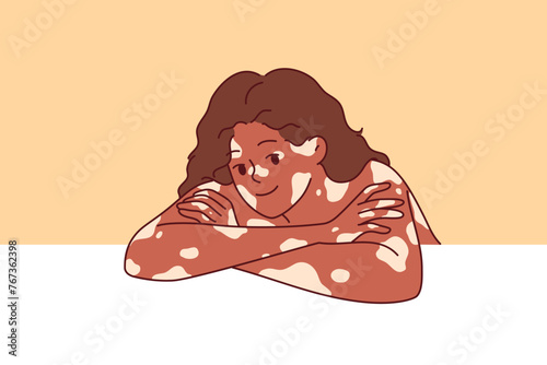 African American woman with vitiligo syndrome and spots on skin smiles, leaning elbows on white surface. Beautiful vitiligo girl calls for attention to dermatological problems caused by pigmentation