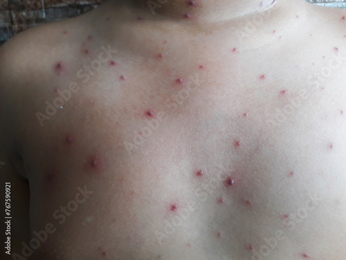 portrait of elementary age boy itching due to chickenpox. Wellness home care treatment chickenpox because varicella zoster virus