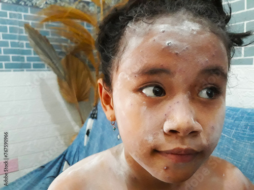 Selective focus portrait of elementary age girl using powder for itching due to chickenpox. Wellness home care treatment chickenpox because varicella zoster virus photo
