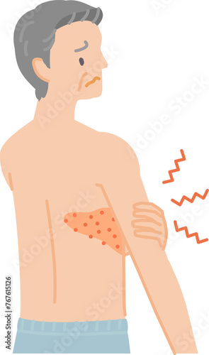 帯状疱疹：背中から胸にかけて痛みやかゆみ、腫れがあるシニア男性（後ろ姿）