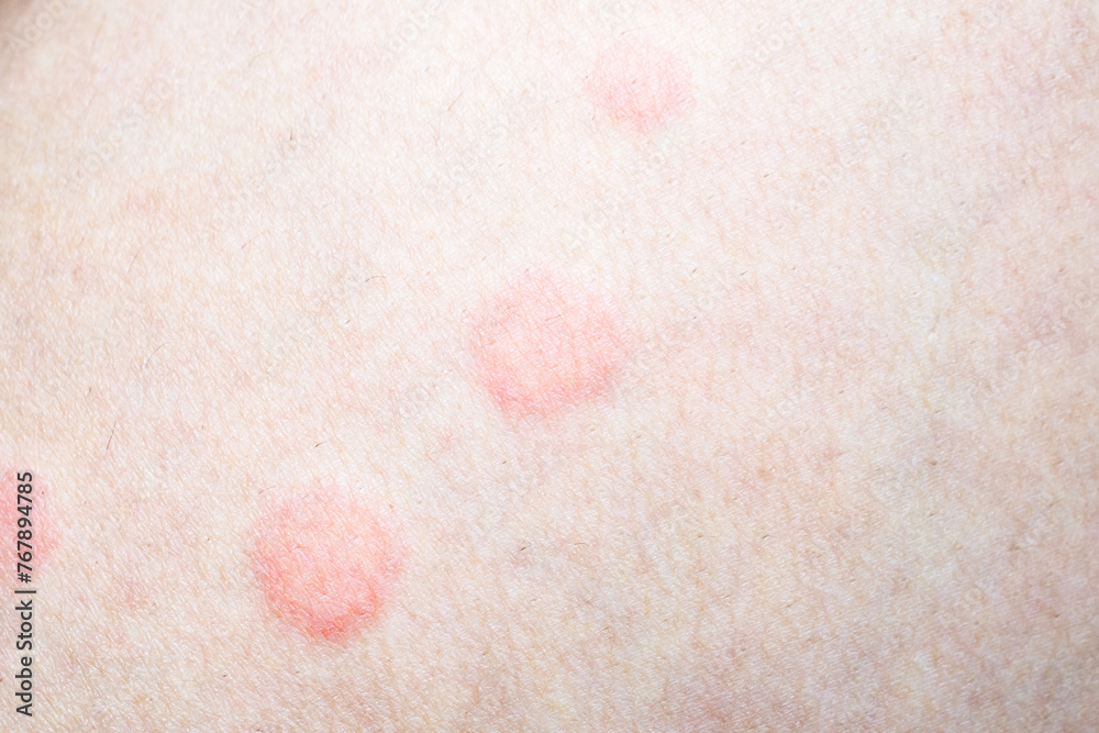Skin allergy rash dermatitis texture close up Skin allergy rash dermatitis texture close up