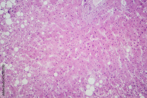 Hepatic steatosis, light micrograph photo