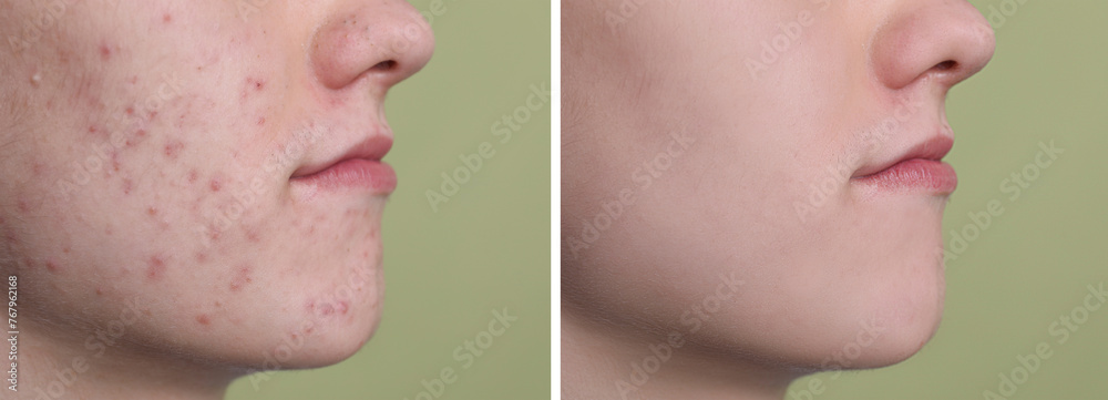 Acne problem. Young man before and after treatment on green background ...