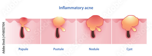 Diagram of inflammatory acne types vector illustration isolated on white background. Papule, pustule, nodule, nodular, nodulocystic, cystic acne and cyst. Skin care and beauty concept.
