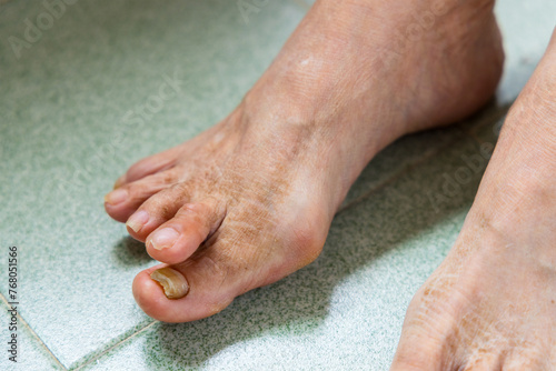 Asian woman suffer from serous Hallux Valgus over the feet toe