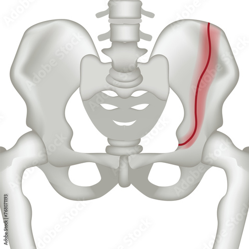 Vertical fracture of the human pelvic bone. Realistic rendering for medical design. Vector illustration