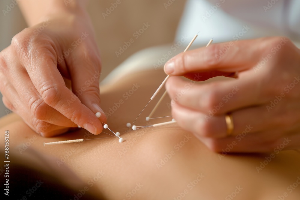 A woman lying on her stomach as a skilled acuprobat performs a procedure on her back using acupressure techniques, Traditional acupuncture therapy being performed, AI Generated A woman lying on her stomach as a skilled acuprobat performs a procedure on her back using acupressure techniques, Traditional acupuncture therapy being performed, AI Generated
