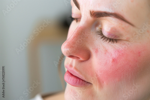 Woman after successful rosacea treatment. Laser treatment of skin problem. Dermatology problem.