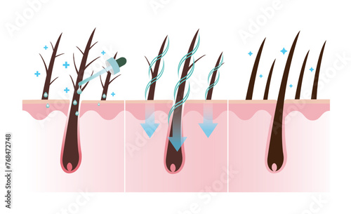 Step of treat damaged hair vector isolated on white background. The mechanism of split ends hair treatment and healthy hair scalp layer. Hair anatomy, hair structure. Hair care concept illustration.