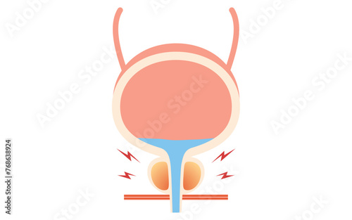 Medical Illustration of Prostate, Prostatitis photo