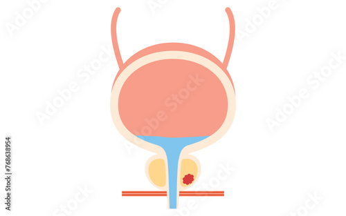 Medical Illustration of Prostate, Stage 2 Prostate Cancer