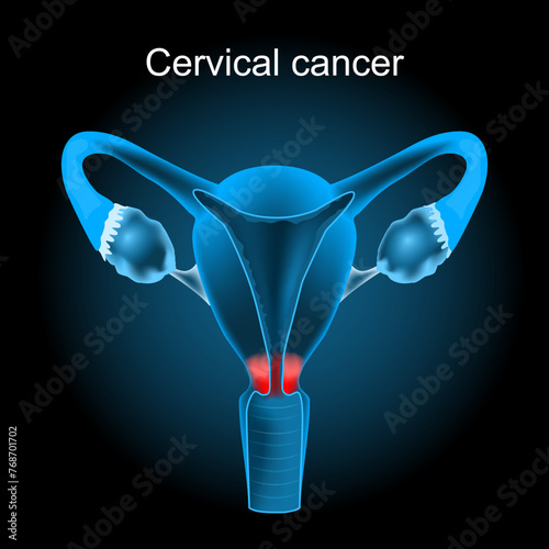 Cervical cancer. Cut-away view of the uterus.
