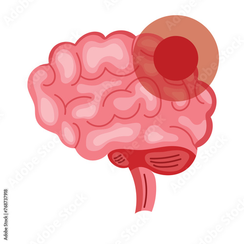 parkinson brain condition