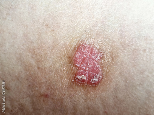 An example of seborrhoeic dermatitis on the skin is a long-term skin disorder photo