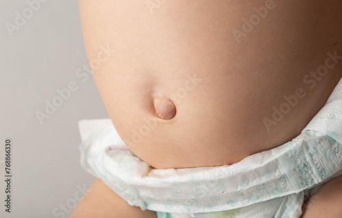 Umbilical hernia in newborns on the stomach, close-up. Treatment of hernias in children without surgery. Convex navel. Children's health.