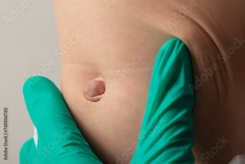 Doctor's hands in green medical gloves examine an umbilical hernia in a child, close-up.