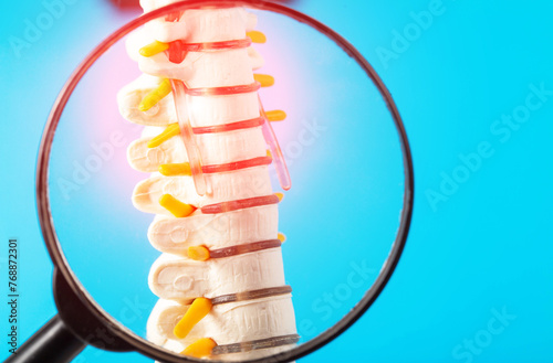 Model of the cervical spine with a compressed nerve root on a blue background under a magnifying glass. Concept of health and diseases of the spine. Orthopedics and vertebrology. 