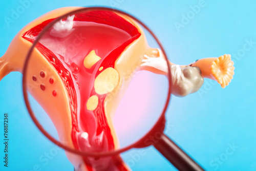 Medical mockup of the female reproductive system under a magnifying glass on a blue background. Concept of inflammation and disease of the cervix. Uterine fibroids and cervical erosion photo