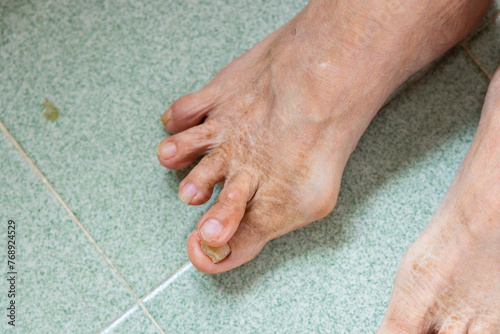 Asian woman suffer from serous Hallux Valgus over the feet toe