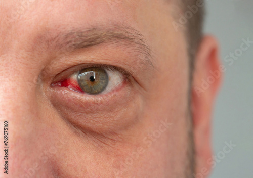 Hemorrhage due to capillary rupture in the man's eye. Detailed image of a man's face with a reddened eye.