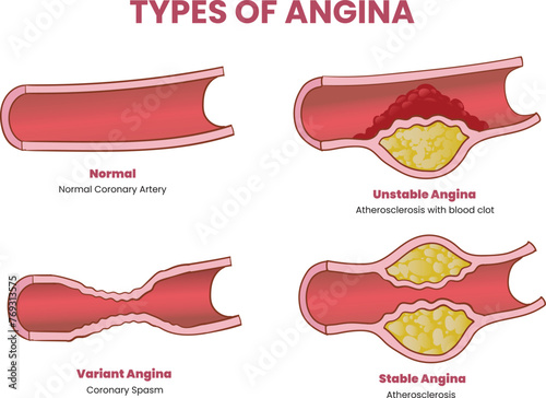 types of angina illustration