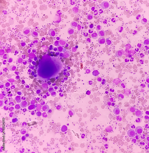 Essential thrombocytosis blood smear showing abnormal high volume of platelet and White Blood Cells. Panmyelosis. Myeloprokiferative disorder. photo