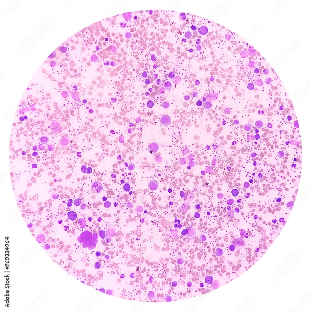 Essential thrombocytosis blood smear showing abnormal high volume of platelet and White Blood Cells. Panmyelosis. Myeloprokiferative disorder.