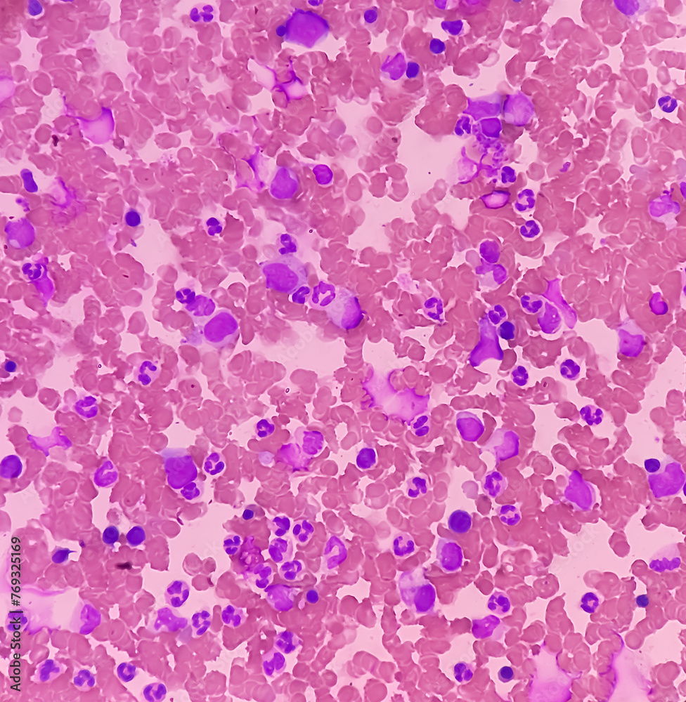 Bone marrow study. Panmyelosis. Myeloproliferative disorder ...