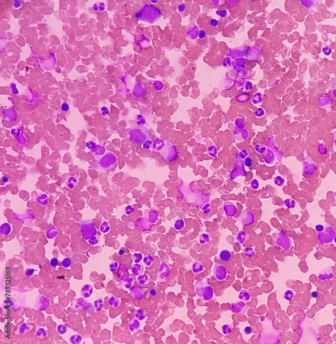 Bone marrow study. Panmyelosis. Myeloproliferative disorder. Thrombocytosis and neutrophilic leukocytosis. photo