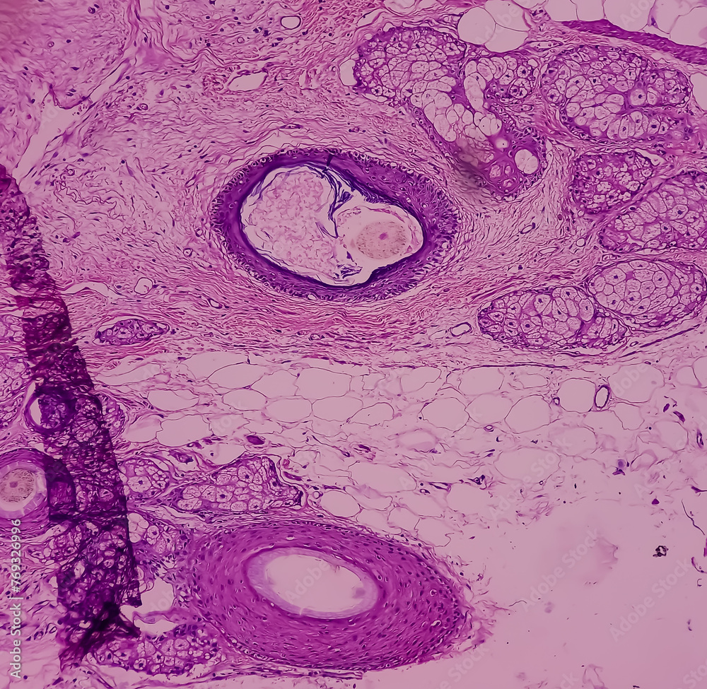 Mature cystic teratoma, Ovarian cyst biopsy, show cyst wall of skin and ...