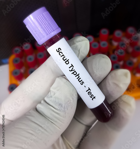 Blood sample for Scrub Typhus blood test with laboratory background. photo