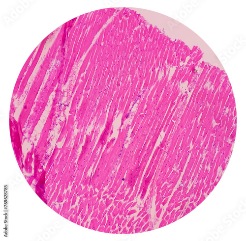 Microscopic image of above knee amputation. Section show fibro collagenous tissue, fatty tissue, skeletal muscles with inflammatory cells. Bony soft tissue resection margin. Bone cancer. photo