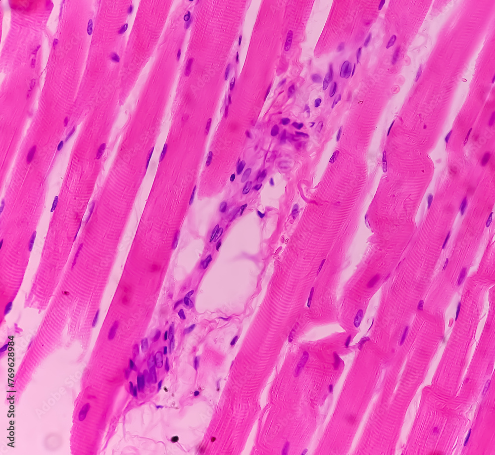 Microscopic image of above knee amputation. Section show fibro ...