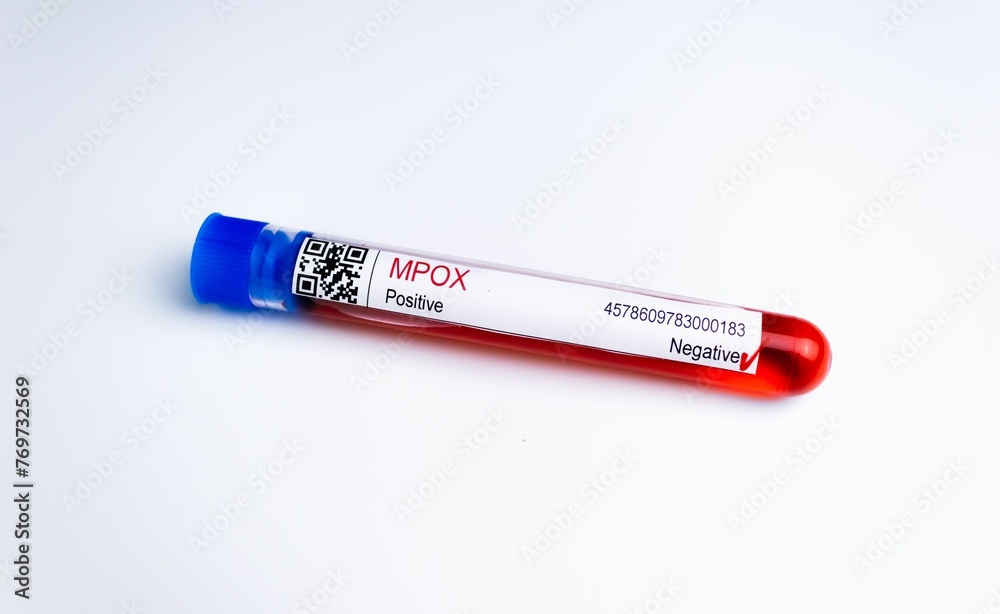 Up of laboratory flask containing blood sample for testing of Monkeypox virus, on white background