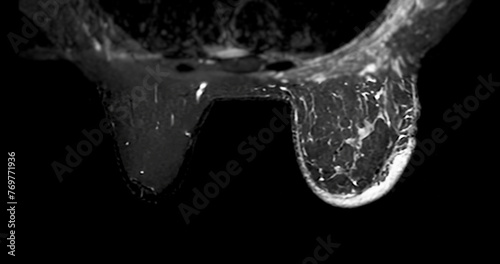Breast MRI revealing BI-RADS 4 in women indicates suspicious findings warranting further investigation for potential malignancy. photo