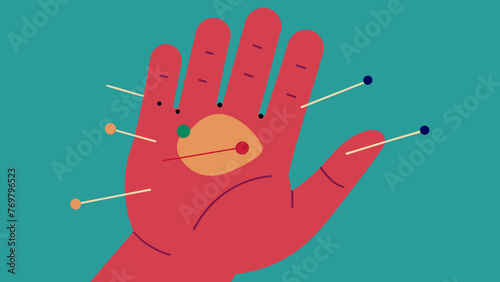  A closeup of the intricate needlework on a patients hand showcasing the numerous points being targeted during the acupuncture treatment.